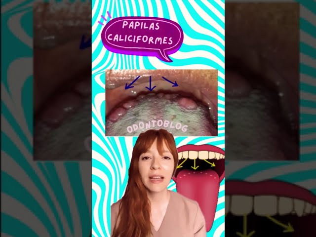 bolitas en la lengua hasta atras