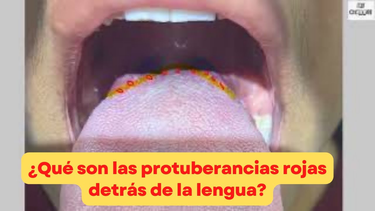 bolas en la lengua en la parte de atras